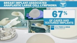 FDA proposes “black-box warning” for breast implants