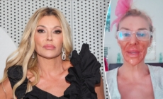 Brandi Glanville burns face with Nair to treat facial parasite condition