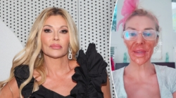 Brandi Glanville burns face with Nair to treat facial parasite condition