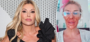 Brandi Glanville burns face with Nair to treat facial parasite condition
