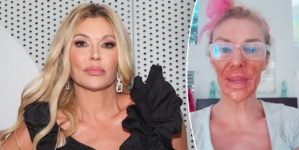 Brandi Glanville burns face with Nair to treat facial parasite condition