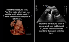 Baby Seen ‘Combing’ Hair On Ultrasound—Shock At What It Looks Like Now