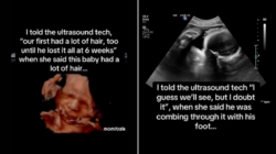 Baby Seen ‘Combing’ Hair On Ultrasound—Shock At What It Looks Like Now