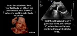 Baby Seen ‘Combing’ Hair On Ultrasound—Shock At What It Looks Like Now