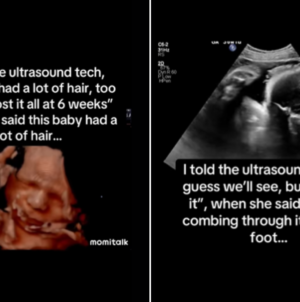 Baby Seen ‘Combing’ Hair On Ultrasound—Shock At What It Looks Like Now