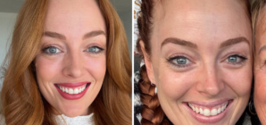 I Thought I Had a Pimple on My Nose, but It Changed My Life Forever